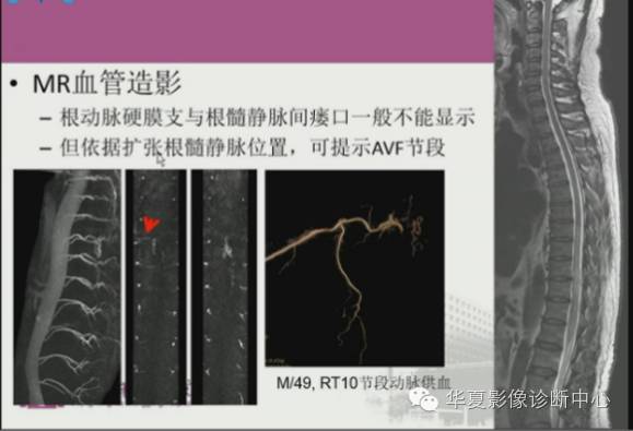 【PPT】脊髓血管畸形：MR诊断