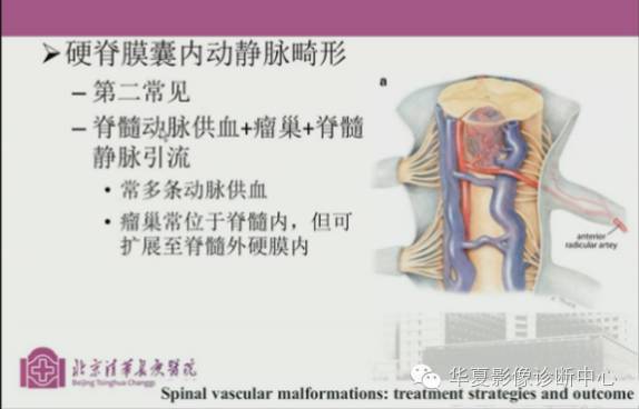 【PPT】脊髓血管畸形：MR诊断