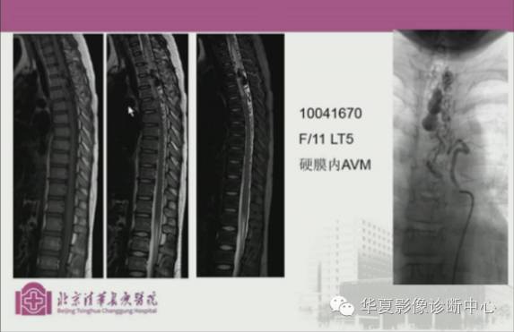【PPT】脊髓血管畸形：MR诊断