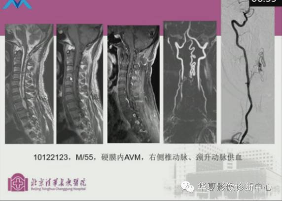 【PPT】脊髓血管畸形：MR诊断