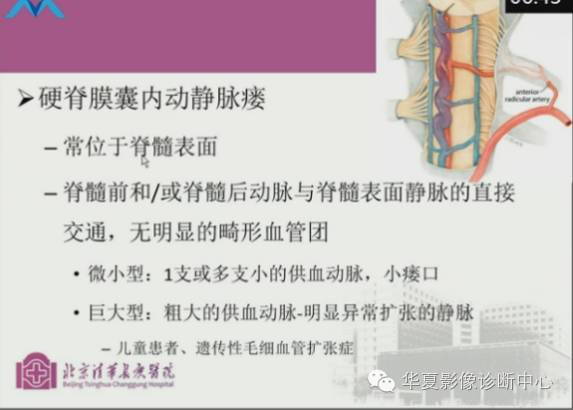 【PPT】脊髓血管畸形：MR诊断
