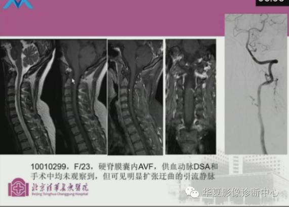 【PPT】脊髓血管畸形：MR诊断