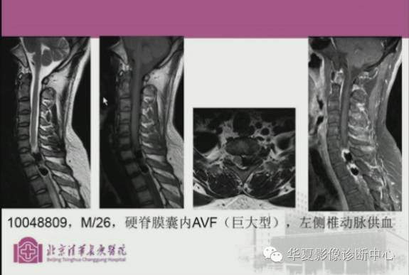 【PPT】脊髓血管畸形：MR诊断