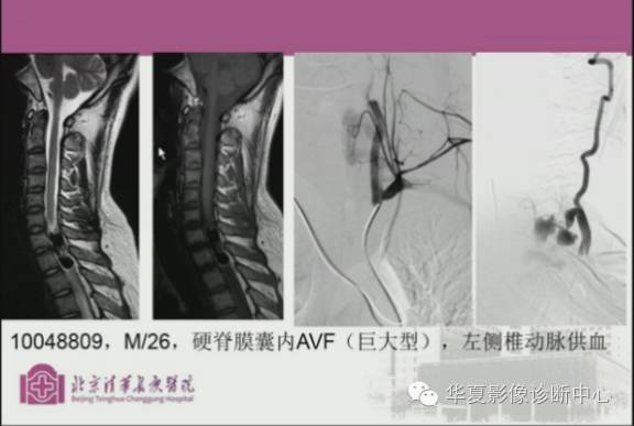 【PPT】脊髓血管畸形：MR诊断