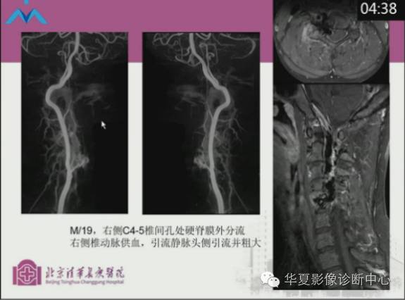 【PPT】脊髓血管畸形：MR诊断