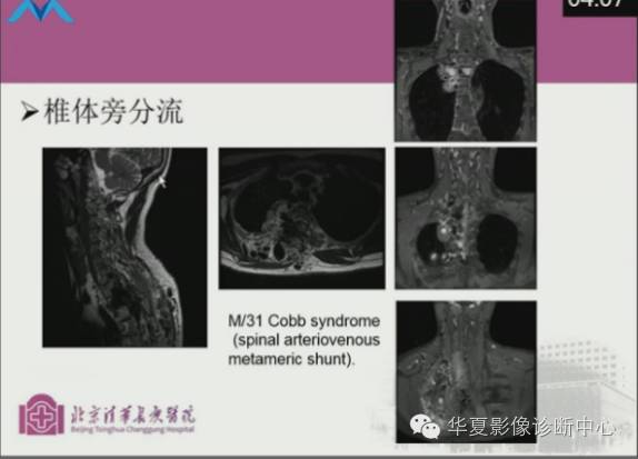【PPT】脊髓血管畸形：MR诊断