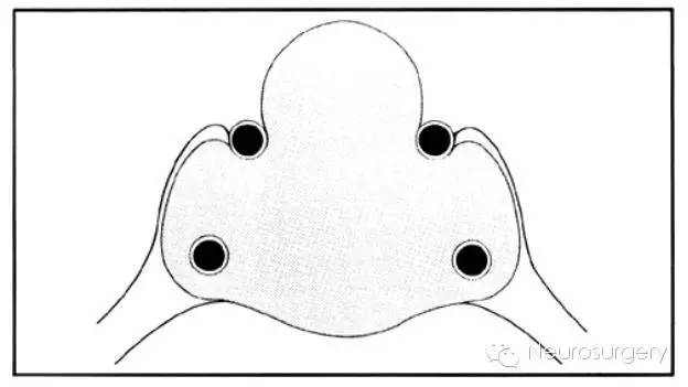 垂体瘤侵袭性分级——Knosp分级
