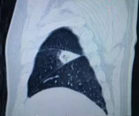 【病例】肺栓塞1例CT影像表现