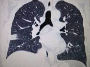 【病例】肺栓塞1例CT影像表现