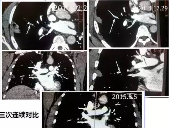 【病例】肺栓塞1例CT影像表现