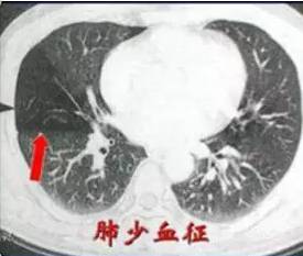 【病例】肺栓塞1例CT影像表现