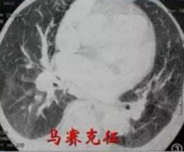 【病例】肺栓塞1例CT影像表现