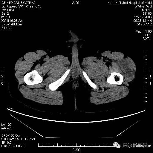 【病例】左大腿骨化性肌炎1例CT影像表现