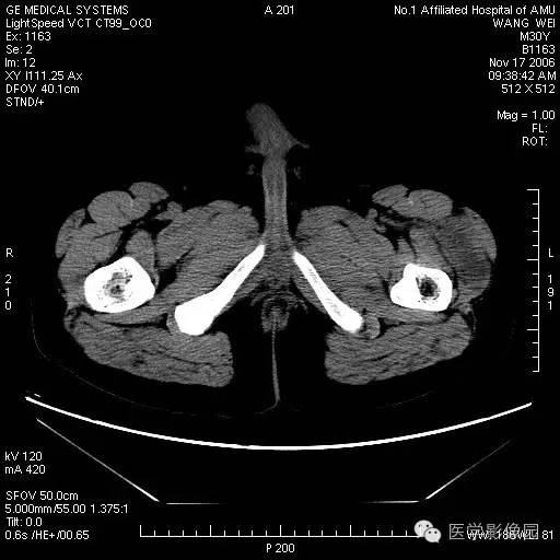 【病例】左大腿骨化性肌炎1例CT影像表现