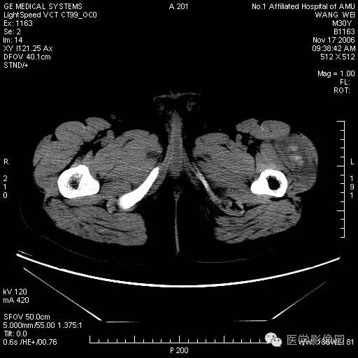 【病例】左大腿骨化性肌炎1例CT影像表现