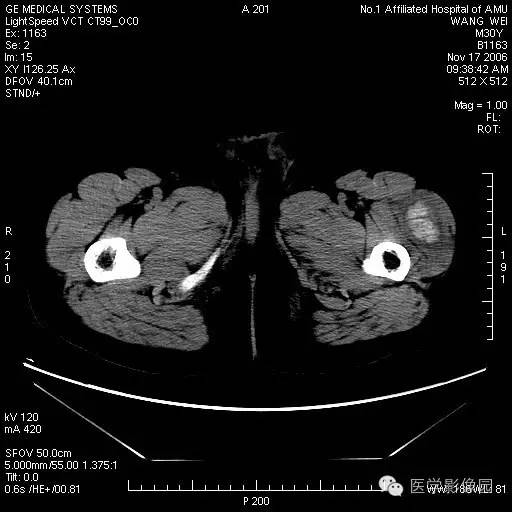 【病例】左大腿骨化性肌炎1例CT影像表现