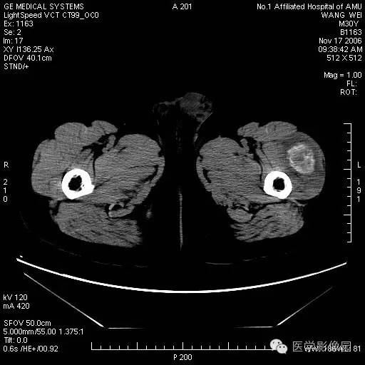 【病例】左大腿骨化性肌炎1例CT影像表现