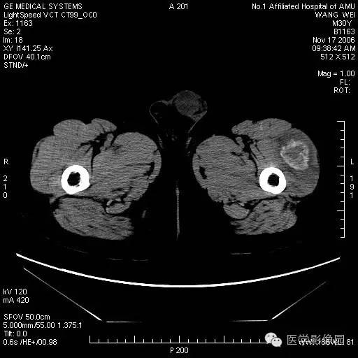 【病例】左大腿骨化性肌炎1例CT影像表现