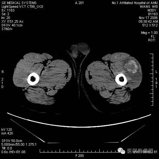 【病例】左大腿骨化性肌炎1例CT影像表现