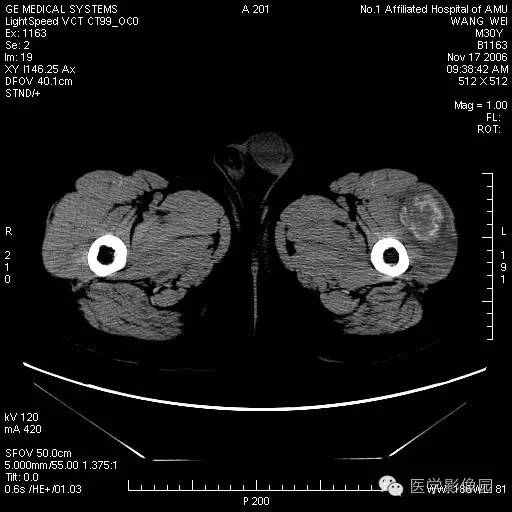 【病例】左大腿骨化性肌炎1例CT影像表现