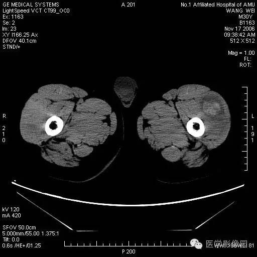【病例】左大腿骨化性肌炎1例CT影像表现