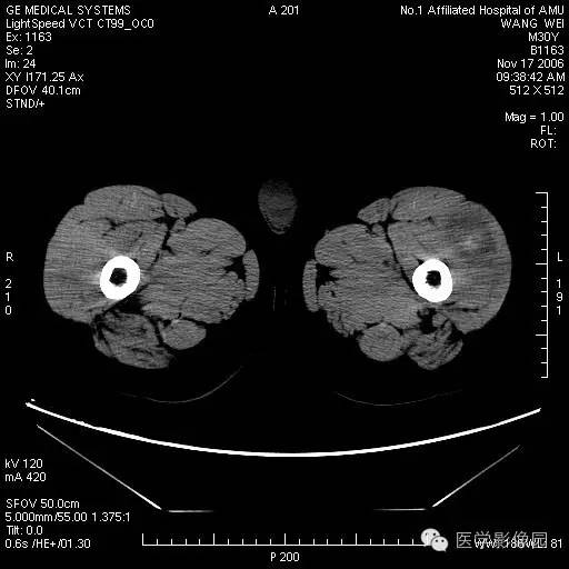 【病例】左大腿骨化性肌炎1例CT影像表现