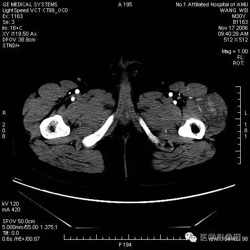 【病例】左大腿骨化性肌炎1例CT影像表现