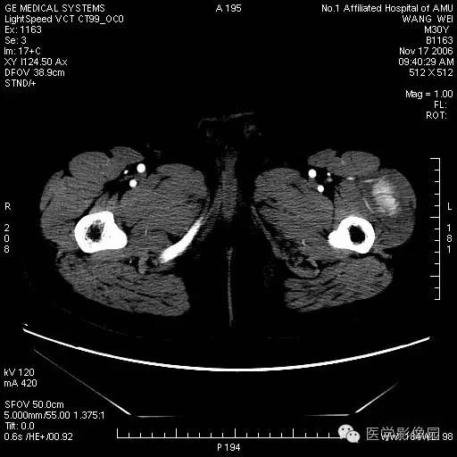 【病例】左大腿骨化性肌炎1例CT影像表现