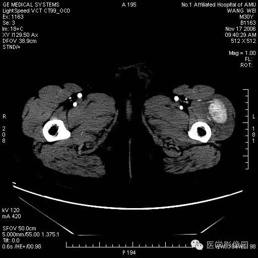 【病例】左大腿骨化性肌炎1例CT影像表现