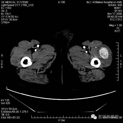 【病例】左大腿骨化性肌炎1例CT影像表现