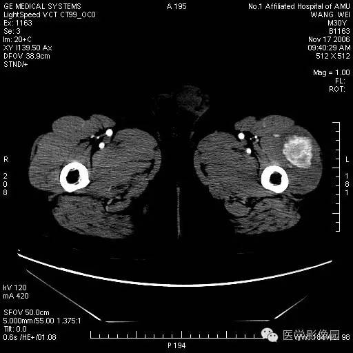 【病例】左大腿骨化性肌炎1例CT影像表现