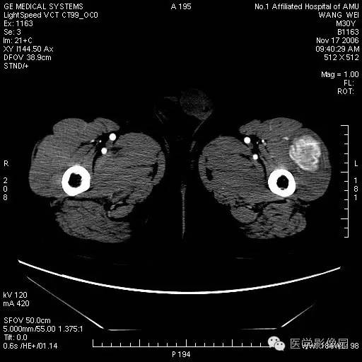 【病例】左大腿骨化性肌炎1例CT影像表现
