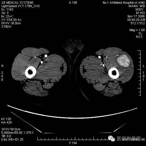 【病例】左大腿骨化性肌炎1例CT影像表现