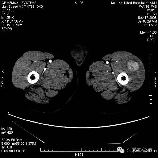 【病例】左大腿骨化性肌炎1例CT影像表现