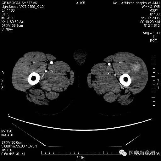 【病例】左大腿骨化性肌炎1例CT影像表现