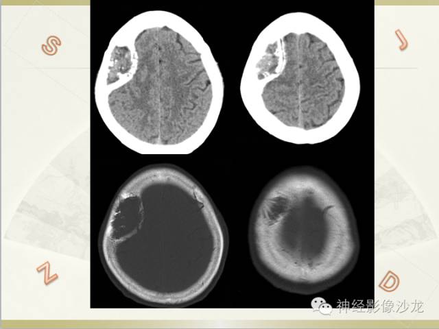 【病例】颅骨占位2例血管瘤VS脑膜瘤CT及MR鉴别诊断