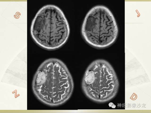 【病例】颅骨占位2例血管瘤VS脑膜瘤CT及MR鉴别诊断