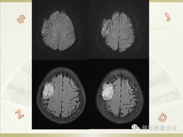 【病例】颅骨占位2例血管瘤VS脑膜瘤CT及MR鉴别诊断