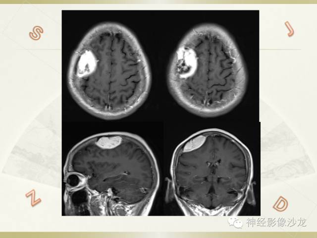 【病例】颅骨占位2例血管瘤VS脑膜瘤CT及MR鉴别诊断