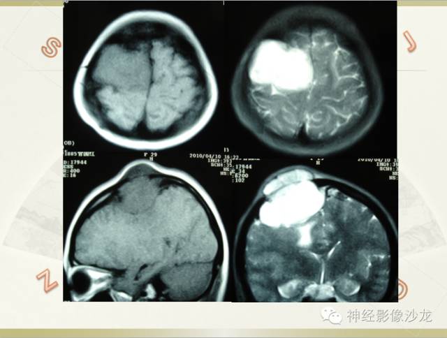 【病例】颅骨占位2例血管瘤VS脑膜瘤CT及MR鉴别诊断