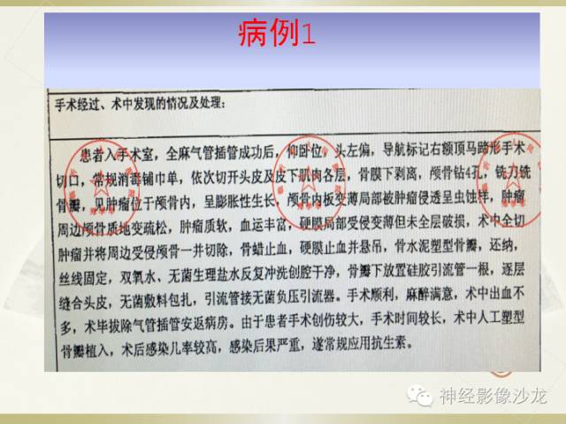 【病例】颅骨占位2例血管瘤VS脑膜瘤CT及MR鉴别诊断