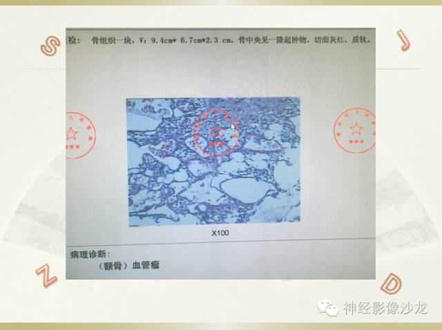 【病例】颅骨占位2例血管瘤VS脑膜瘤CT及MR鉴别诊断