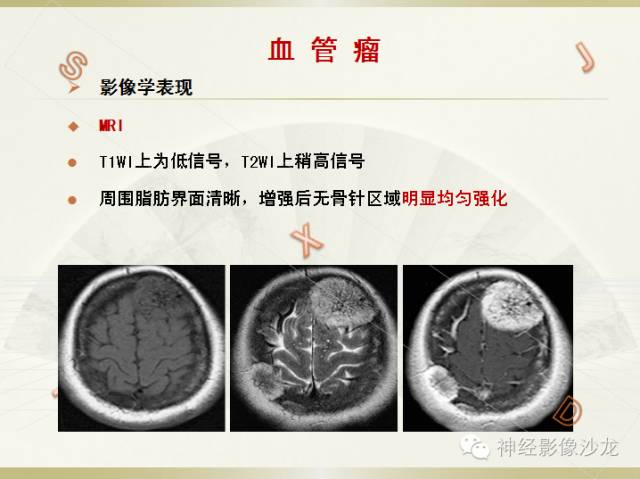 【病例】颅骨占位2例血管瘤VS脑膜瘤CT及MR鉴别诊断