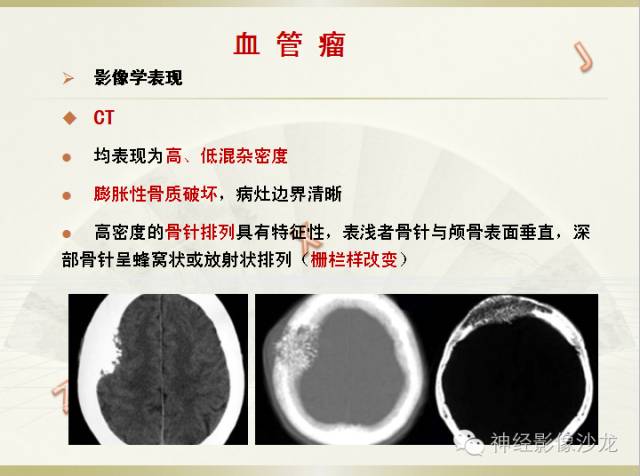 【病例】颅骨占位2例血管瘤VS脑膜瘤CT及MR鉴别诊断