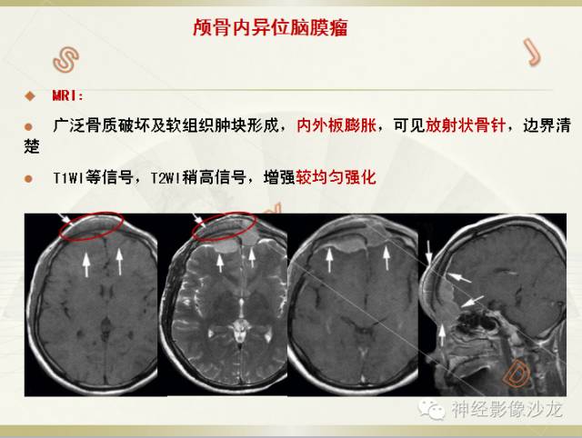 【病例】颅骨占位2例血管瘤VS脑膜瘤CT及MR鉴别诊断