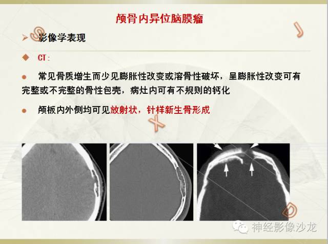【病例】颅骨占位2例血管瘤VS脑膜瘤CT及MR鉴别诊断