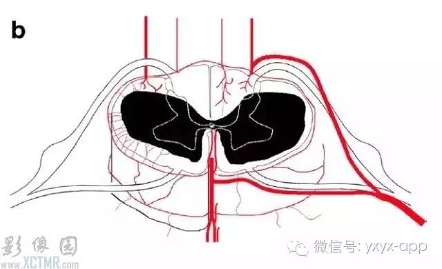 脊髓缺血综合征影像学评估 脊髓缺血综合征影像学评估