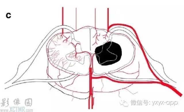 脊髓缺血综合征影像学评估 脊髓缺血综合征影像学评估