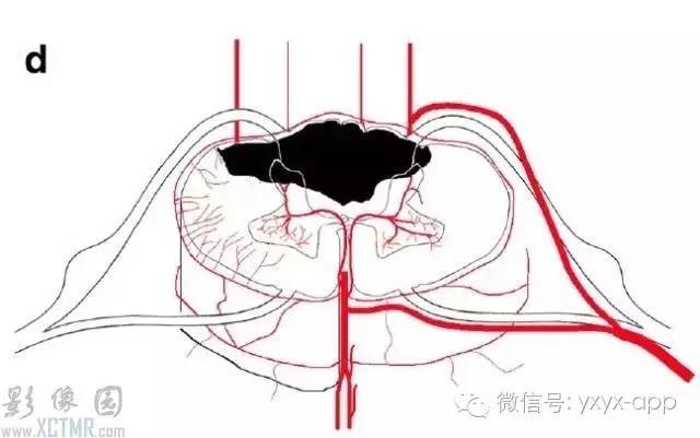 脊髓缺血综合征影像学评估 脊髓缺血综合征影像学评估
