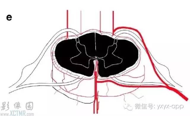 脊髓缺血综合征影像学评估 脊髓缺血综合征影像学评估
